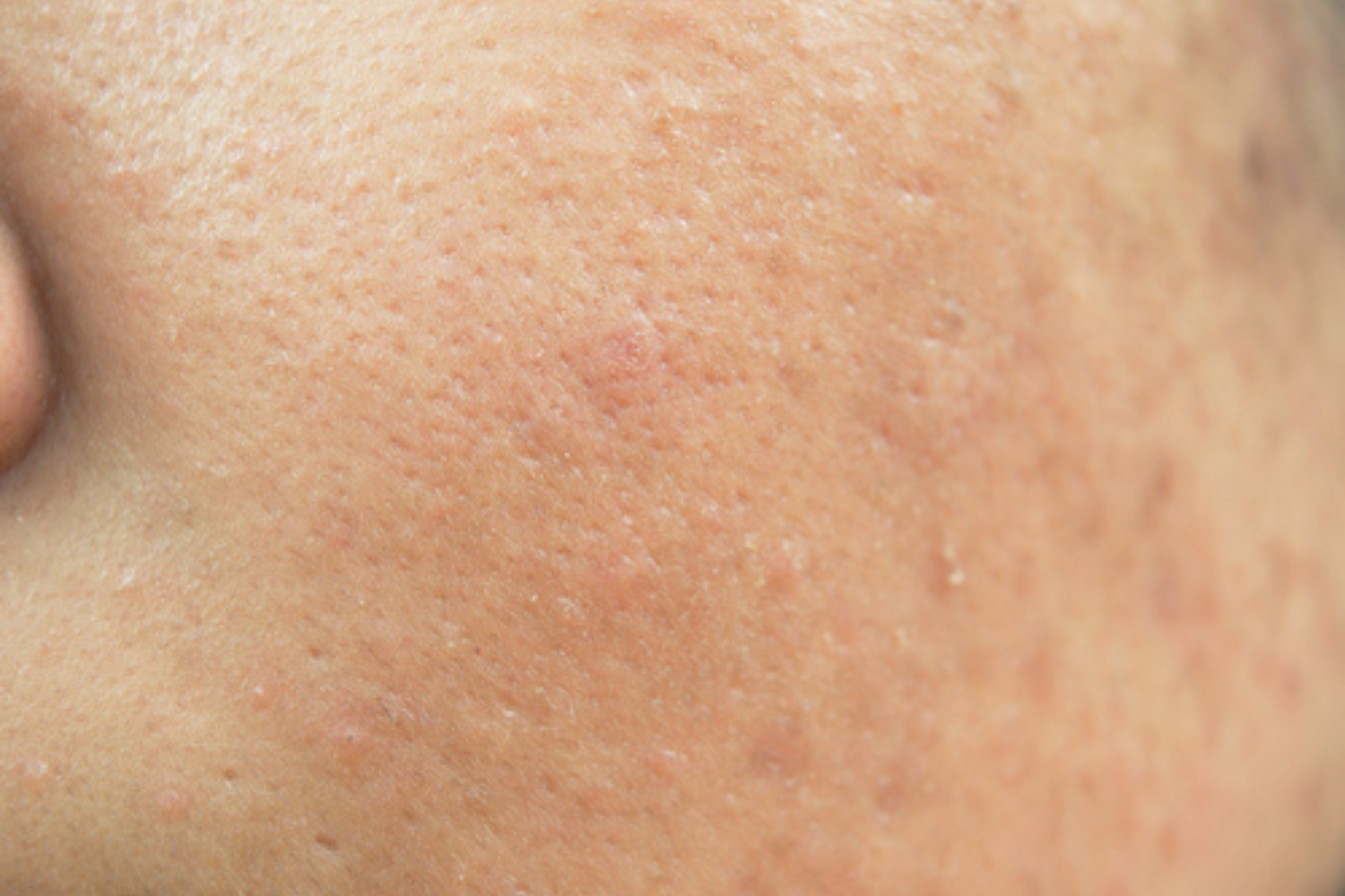 What are sebaceous filaments?