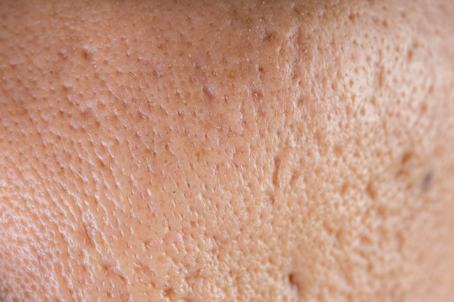 Post-acne scarring: what are your treatment options?