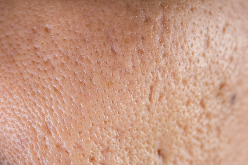 Post-acne scarring: what are your treatment options?