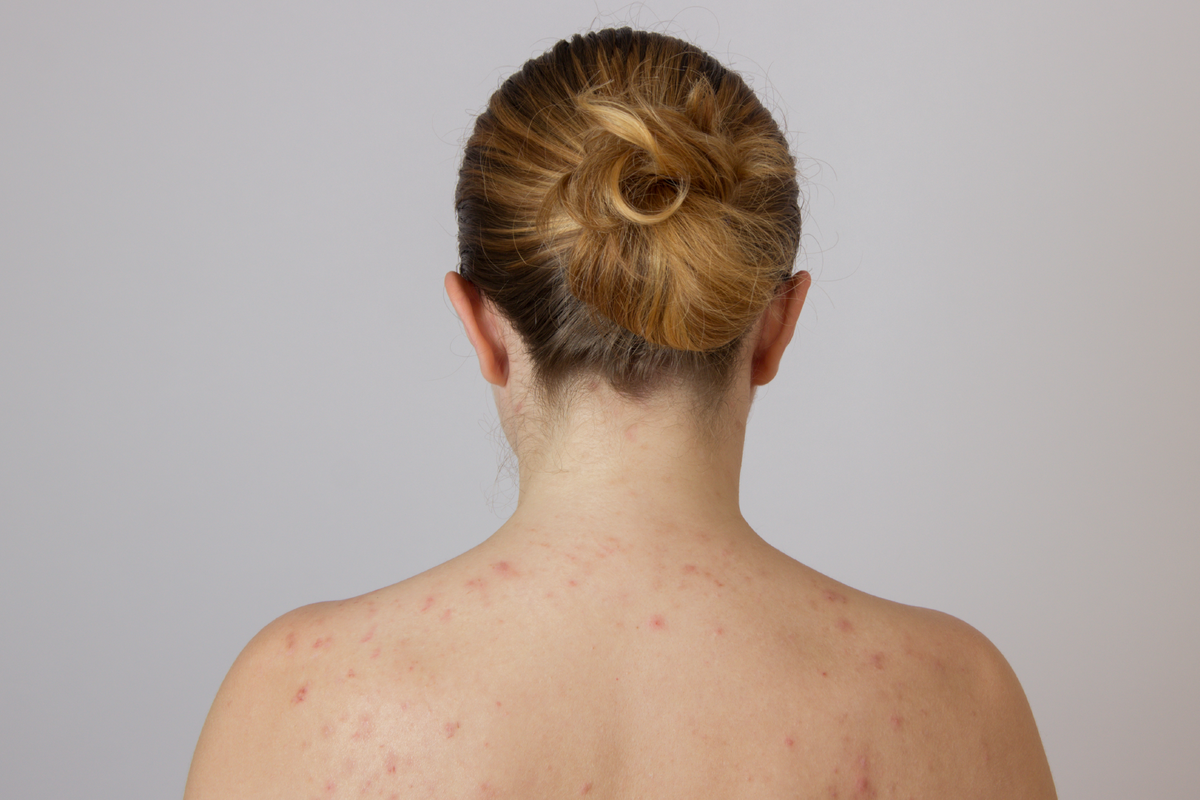 Do you suffer from body acne?