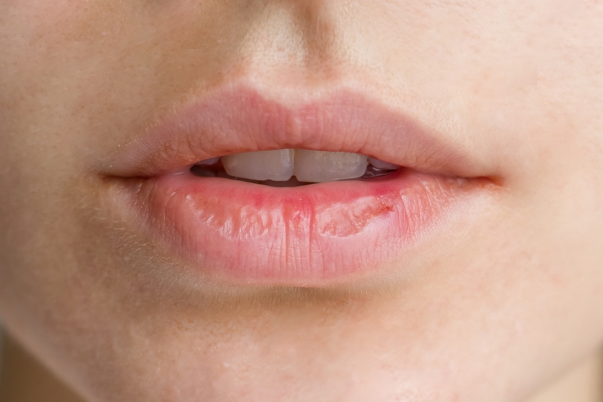 What actually helps with dry lips in winter?