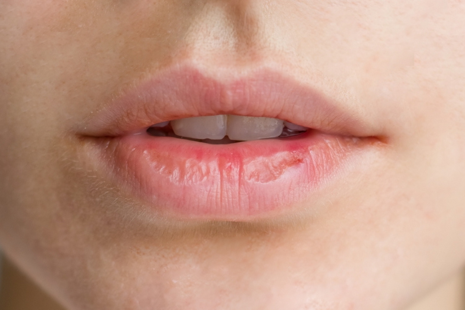 What actually helps with dry lips in winter?