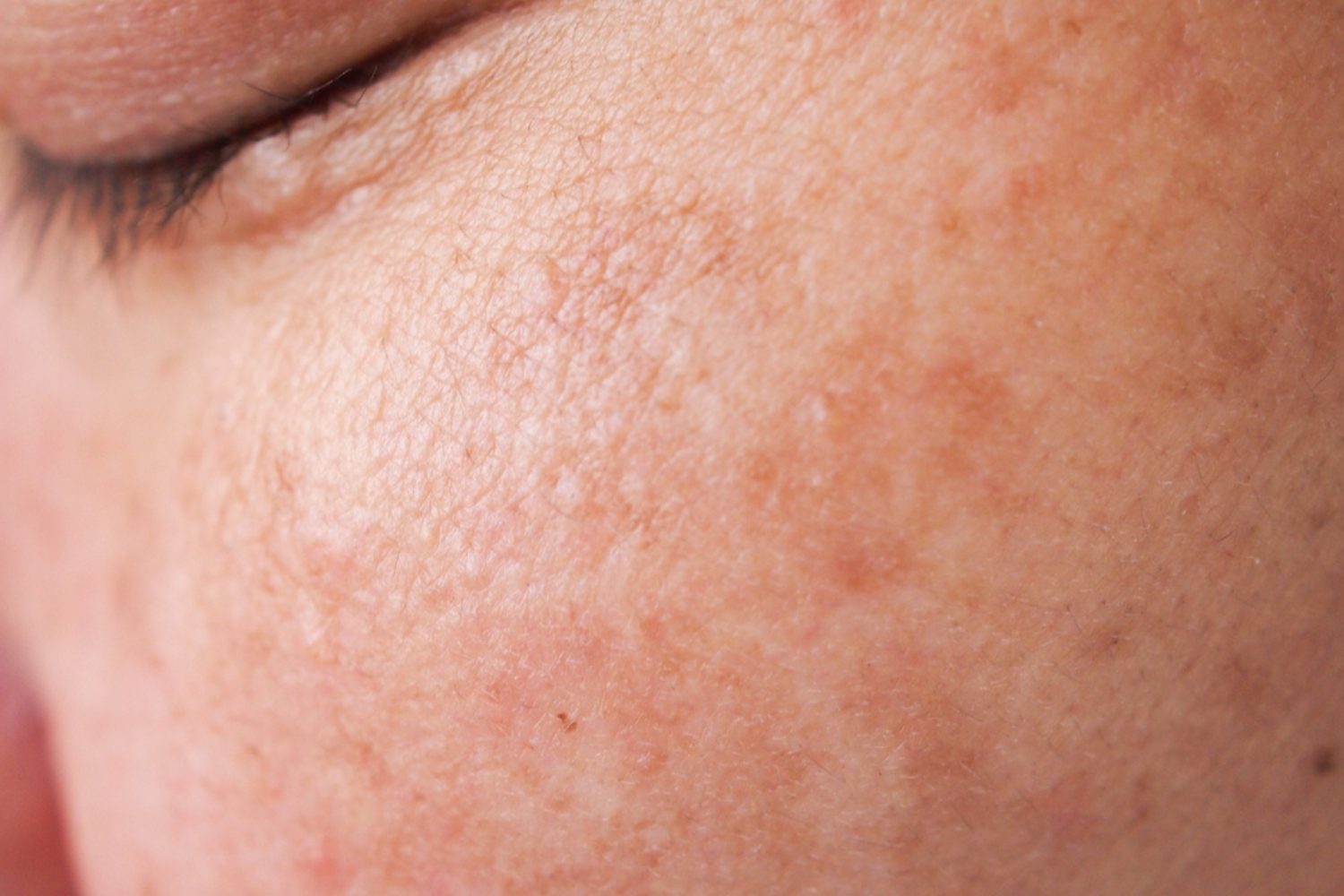 5 Things That Can Happen To Skin During Menopause