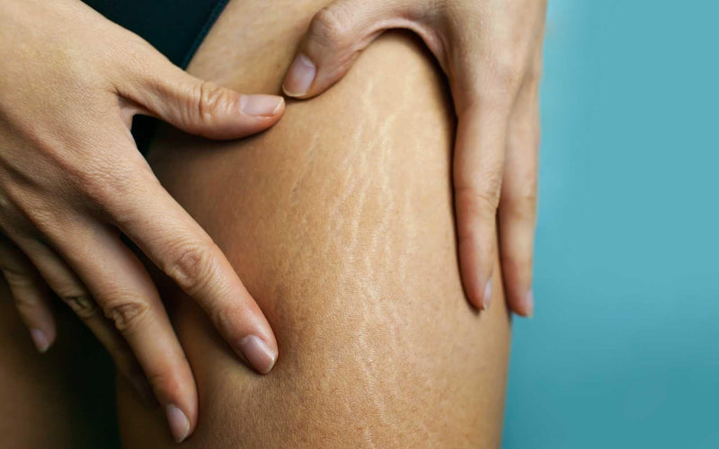 4 ways to reduce the appearance of your stretch marks